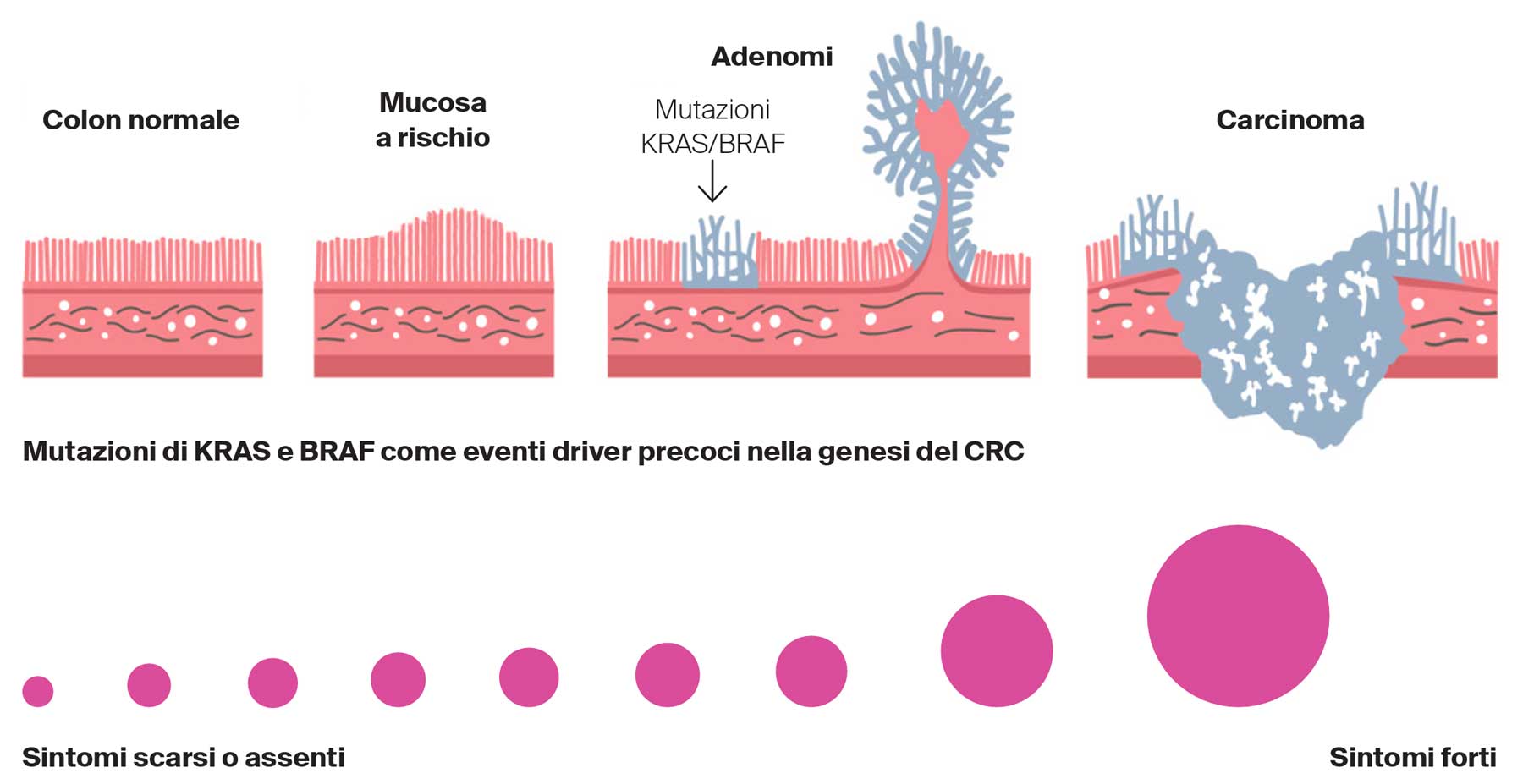 Mutazioni di KRAS e BRAF come eventi driver precoci nella genesi del CRC