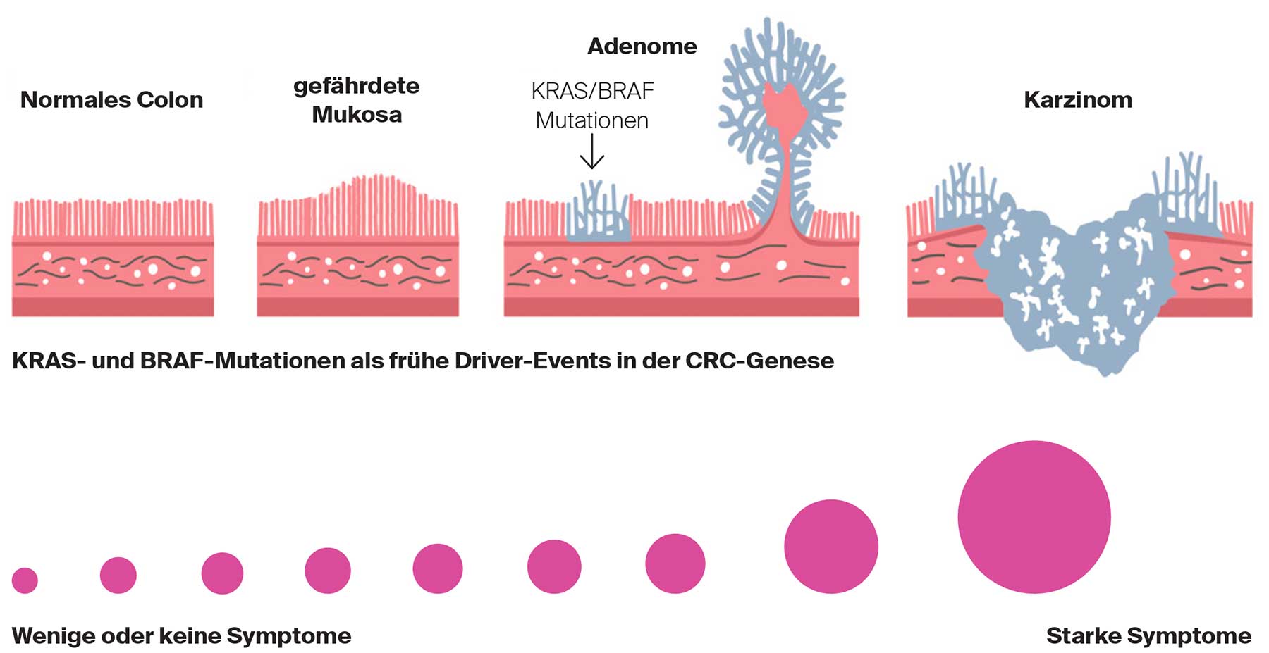 KRAS- und BRAF-Mutationen als frühe Driver-Events in der CRC-Genese