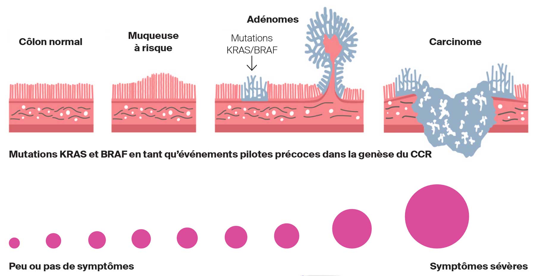 Mutations KRAS et BRAF en tant qu’événements pilotes précoces dans la genèse du CCR